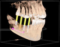 3D-Implantatplanung